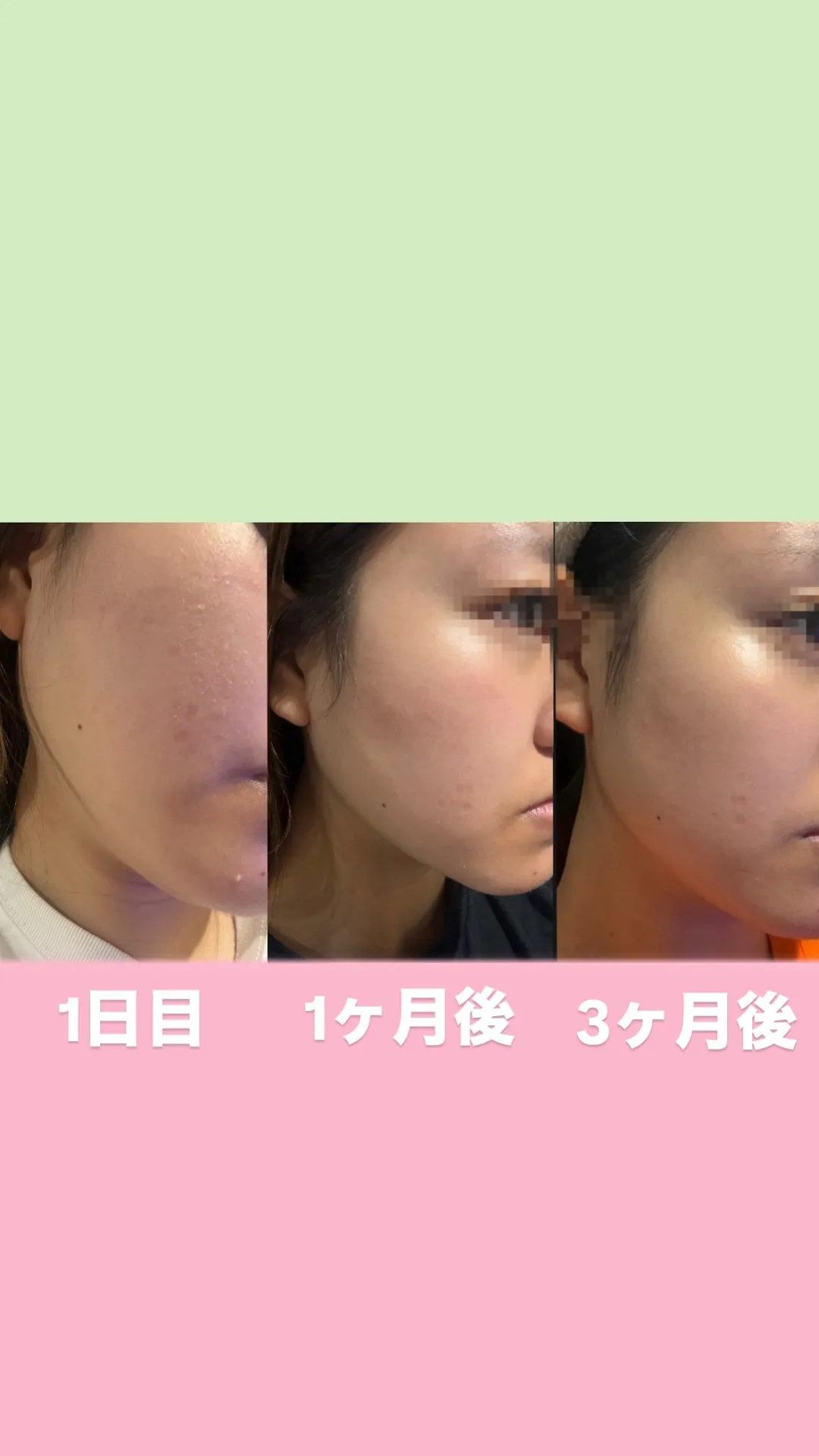 エステWAM 紫外線とニキビ